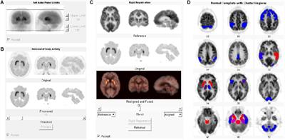 Quantitative Research of 11C-CFT and 18F-FDG PET in Parkinson’s Disease: A Pilot Study With NeuroQ Software